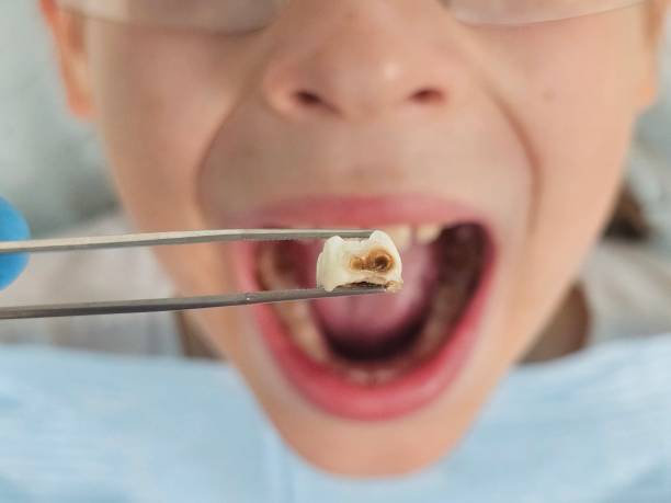 Best Emergency Root Canal Treatment in Glandorf, OH